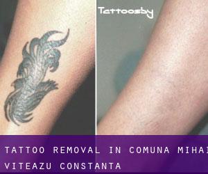 Tattoo Removal in Comuna Mihai Viteazu (Constanţa)