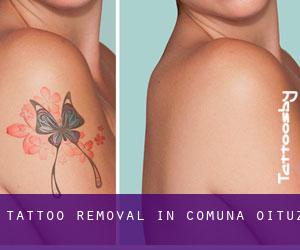Tattoo Removal in Comuna Oituz