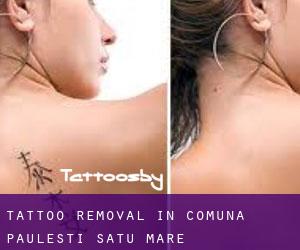Tattoo Removal in Comuna Pãuleşti (Satu Mare)