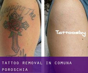 Tattoo Removal in Comuna Poroschia