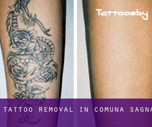 Tattoo Removal in Comuna Sagna