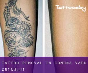 Tattoo Removal in Comuna Vadu Crişului