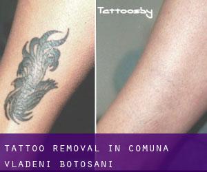 Tattoo Removal in Comuna Vlădeni (Botoşani)