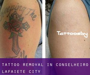 Tattoo Removal in Conselheiro Lafaiete (City)