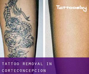 Tattoo Removal in Corteconcepción