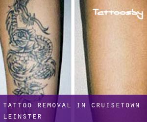 Tattoo Removal in Cruisetown (Leinster)