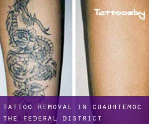 Tattoo Removal in Cuauhtémoc (The Federal District)