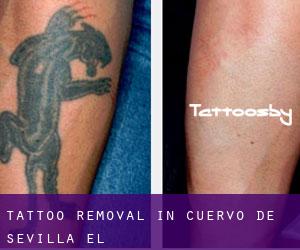 Tattoo Removal in Cuervo de Sevilla (El)