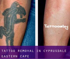 Tattoo Removal in Cyprusdale (Eastern Cape)