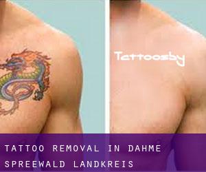 Tattoo Removal in Dahme-Spreewald Landkreis