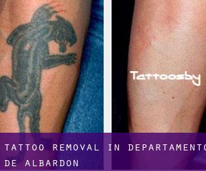 Tattoo Removal in Departamento de Albardón