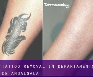 Tattoo Removal in Departamento de Andalgalá
