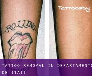 Tattoo Removal in Departamento de Itatí
