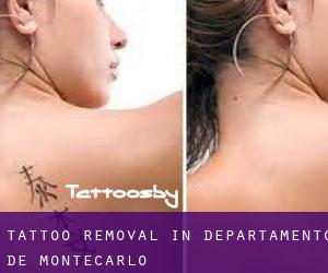 Tattoo Removal in Departamento de Montecarlo
