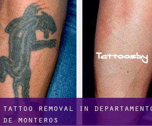 Tattoo Removal in Departamento de Monteros