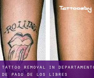 Tattoo Removal in Departamento de Paso de los Libres