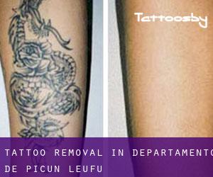 Tattoo Removal in Departamento de Picún Leufú