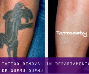 Tattoo Removal in Departamento de Quemú Quemú