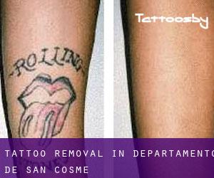 Tattoo Removal in Departamento de San Cosme