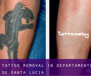 Tattoo Removal in Departamento de Santa Lucía