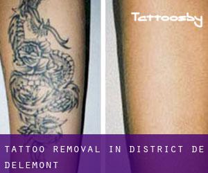 Tattoo Removal in District de Delémont