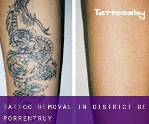 Tattoo Removal in District de Porrentruy