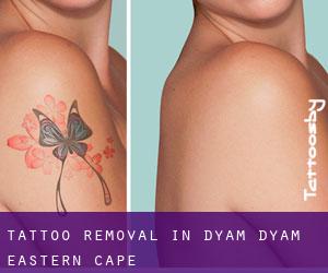 Tattoo Removal in Dyam-Dyam (Eastern Cape)