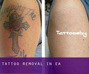 Tattoo Removal in Ea