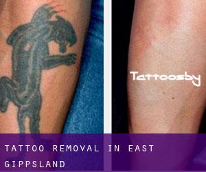 Tattoo Removal in East Gippsland