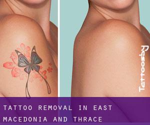 Tattoo Removal in East Macedonia and Thrace