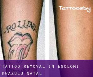 Tattoo Removal in Egolomi (KwaZulu-Natal)