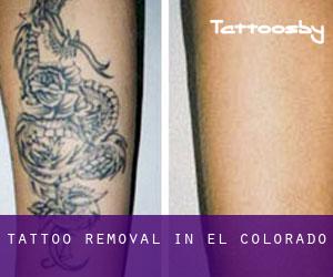 Tattoo Removal in El Colorado