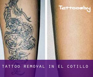 Tattoo Removal in El Cotillo