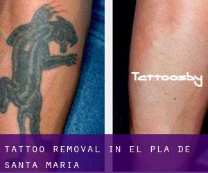 Tattoo Removal in El Pla de Santa Maria