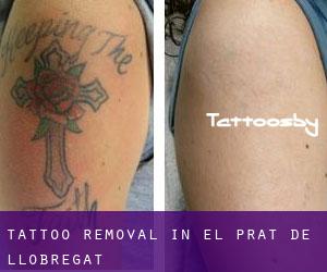 Tattoo Removal in el Prat de Llobregat