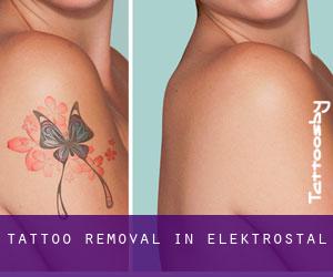 Tattoo Removal in Elektrostal