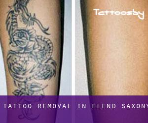 Tattoo Removal in Elend (Saxony)