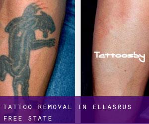 Tattoo Removal in Ellasrus (Free State)