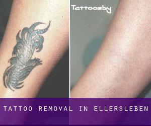 Tattoo Removal in Ellersleben