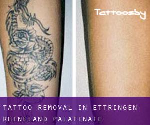 Tattoo Removal in Ettringen (Rhineland-Palatinate)