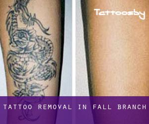 Tattoo Removal in Fall Branch