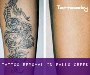 Tattoo Removal in Falls Creek