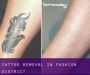 Tattoo Removal in Fashion District