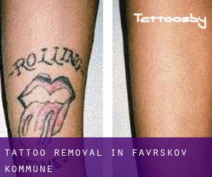 Tattoo Removal in Favrskov Kommune