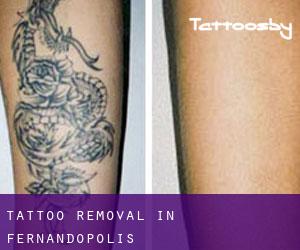 Tattoo Removal in Fernandópolis
