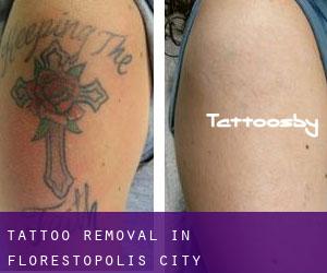 Tattoo Removal in Florestópolis (City)