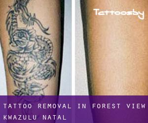 Tattoo Removal in Forest View (KwaZulu-Natal)