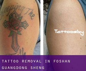 Tattoo Removal in Foshan (Guangdong Sheng)