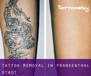 Tattoo Removal in Frankenthal Stadt