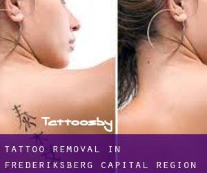 Tattoo Removal in Frederiksberg (Capital Region)